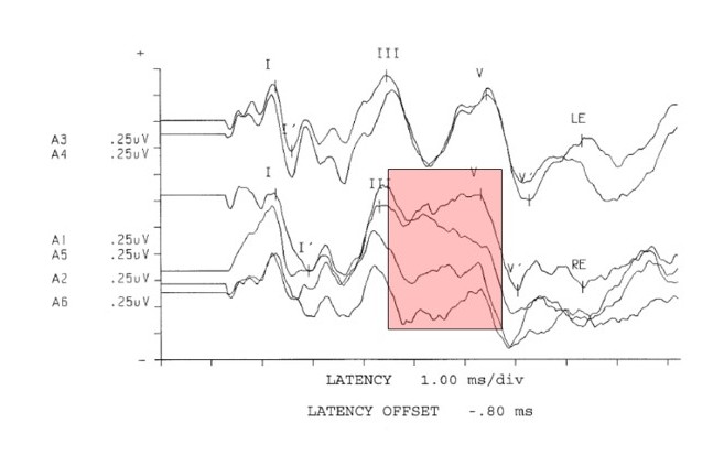 Figure 1. Neurodignostic click (80 db nHL) auditory brainstem response