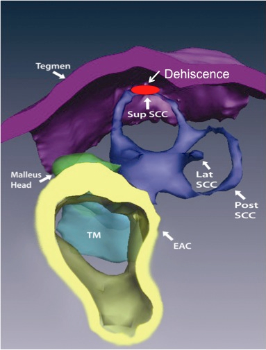 Tegmen Tympani Dehiscence