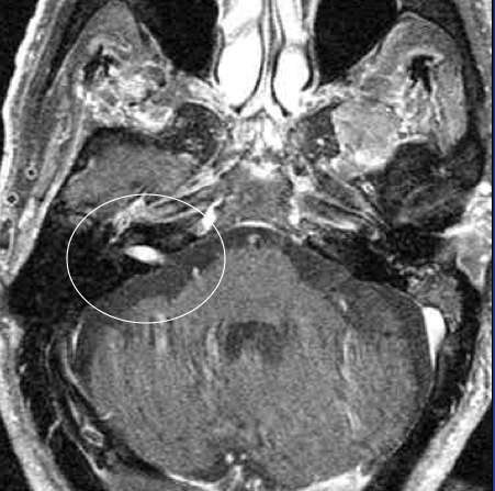 Vestibular Schwannomas or Acoustic Neuromas by Another Name | Canadian