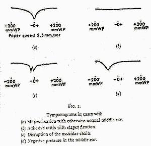 Figure 10 Liden-tympanogram-shapes