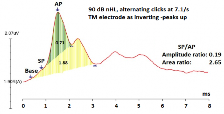Moving from Bedside to Clinic: Electrocochleography Applications ...