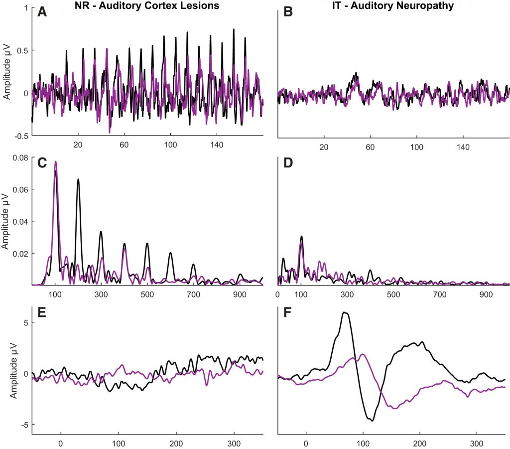 Mysteries of the Hearing Brain – Is It ANSD or Cortical Deafness?