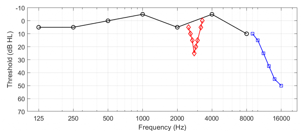 Tinnitus with a Normal Audiogram | Canadian Audiologist