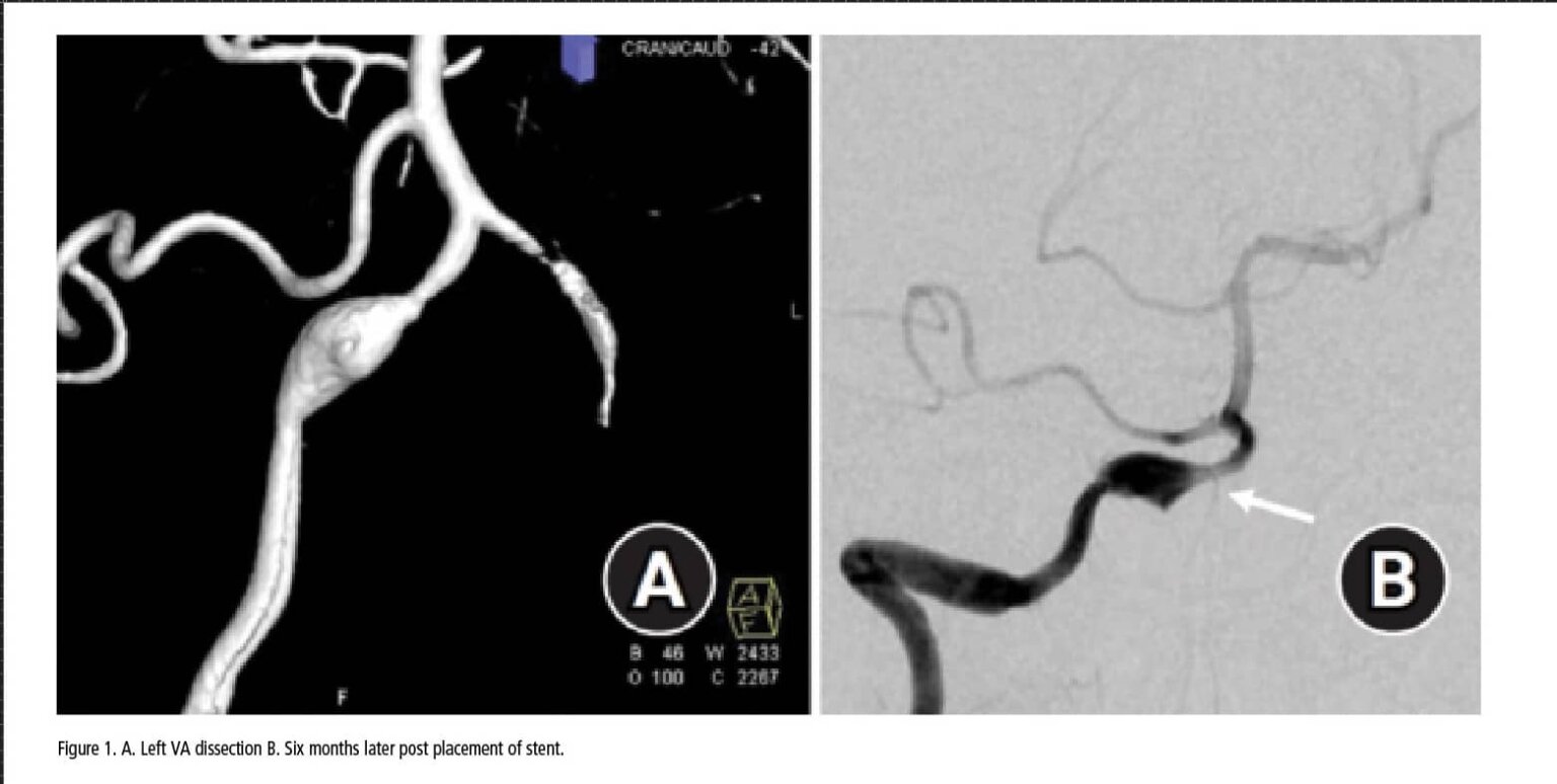 Stented Dissection Figure 1_VA dissection-Stent_cropped_web | Canadian Audiologist